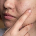What is Acne and What Are The Best Home Remedies For Treating It?